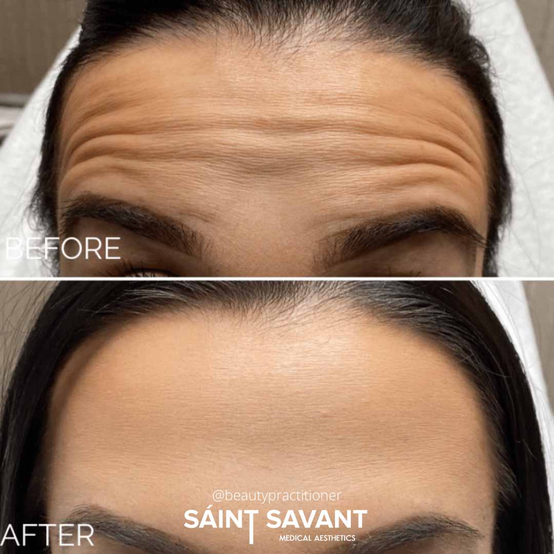 A woman's face before and after Botox in Chino Hills.