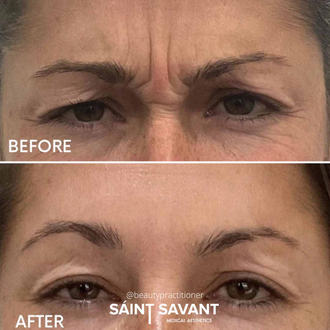 A woman's face before and after Botox in Chino Hills.