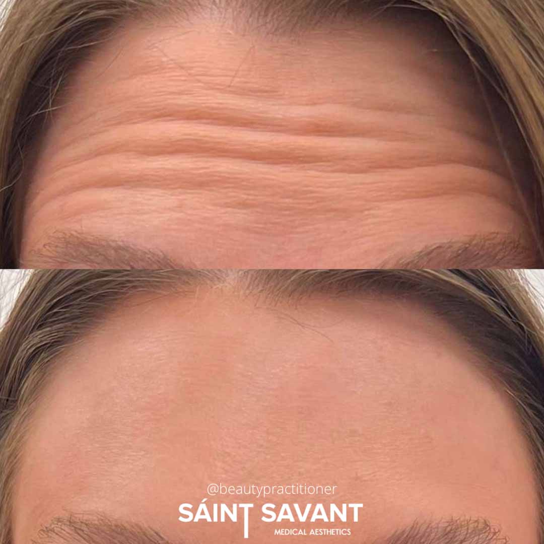 BOTOX® in Chino Hills, CA | Saint Savant Medical Aesthetics