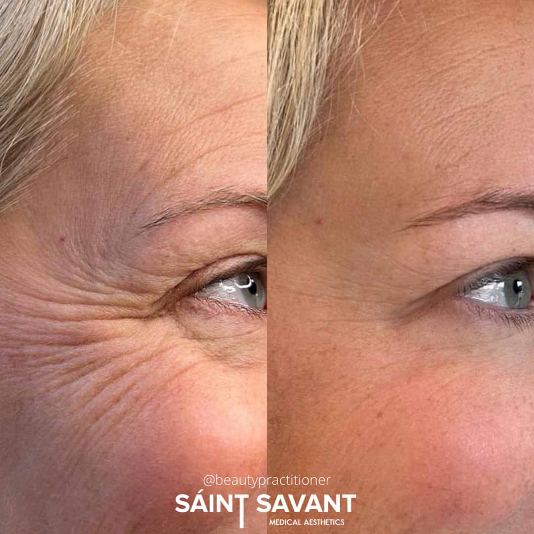 A woman's face before and after Botox in Chino Hills.