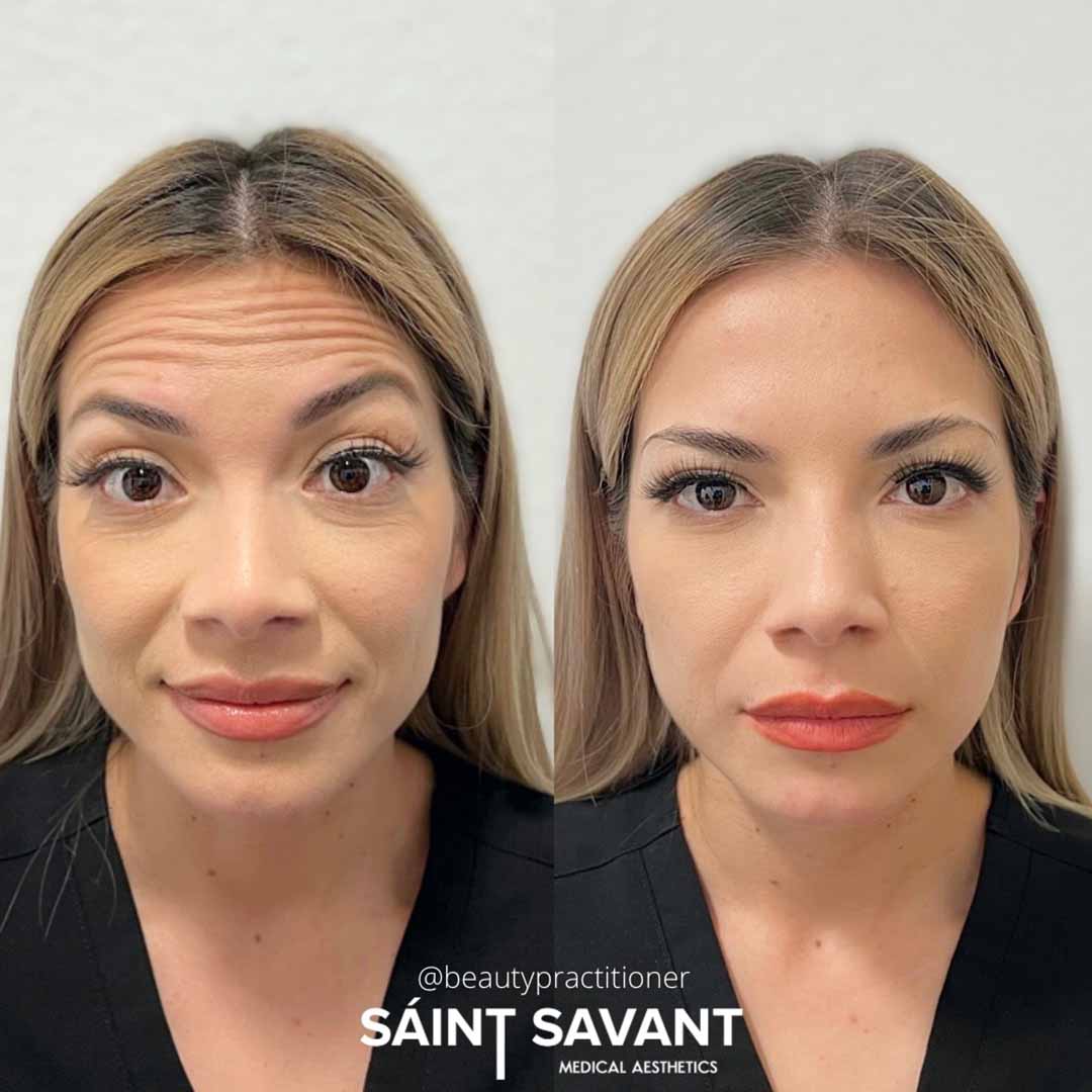 A woman's face before and after Botox in Chino Hills.