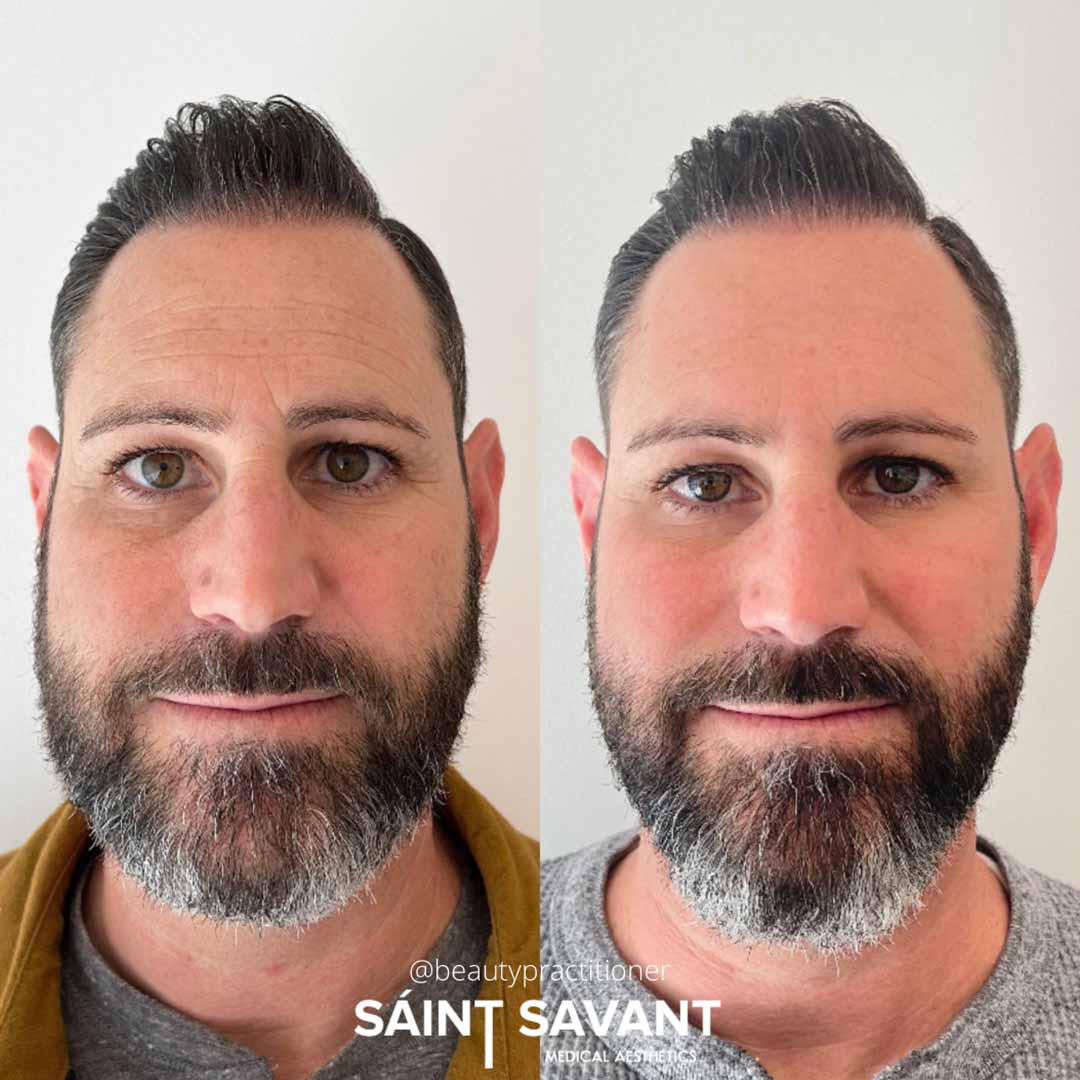 A man's face before and after Botox in Chino Hills.