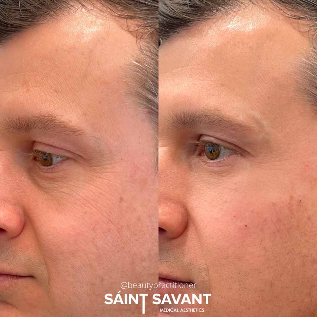 A man's face before and after Botox in Chino Hills.