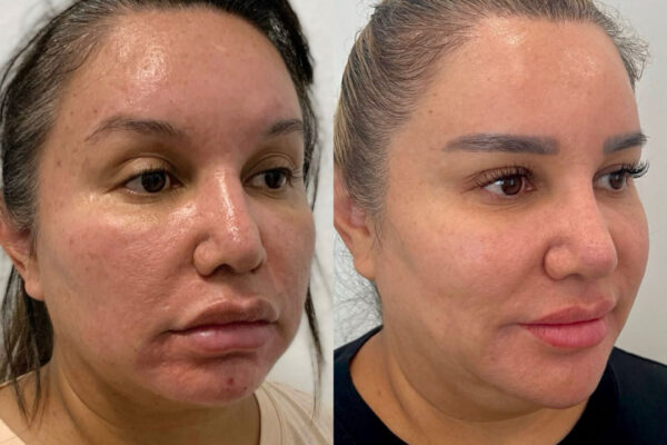 lasemd-10b lasemd-10b