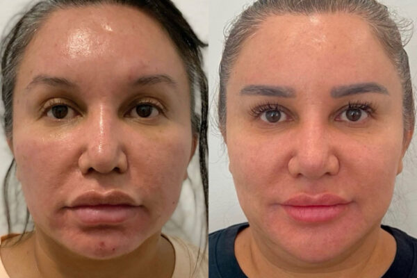 lasemd-10d lasemd-10d