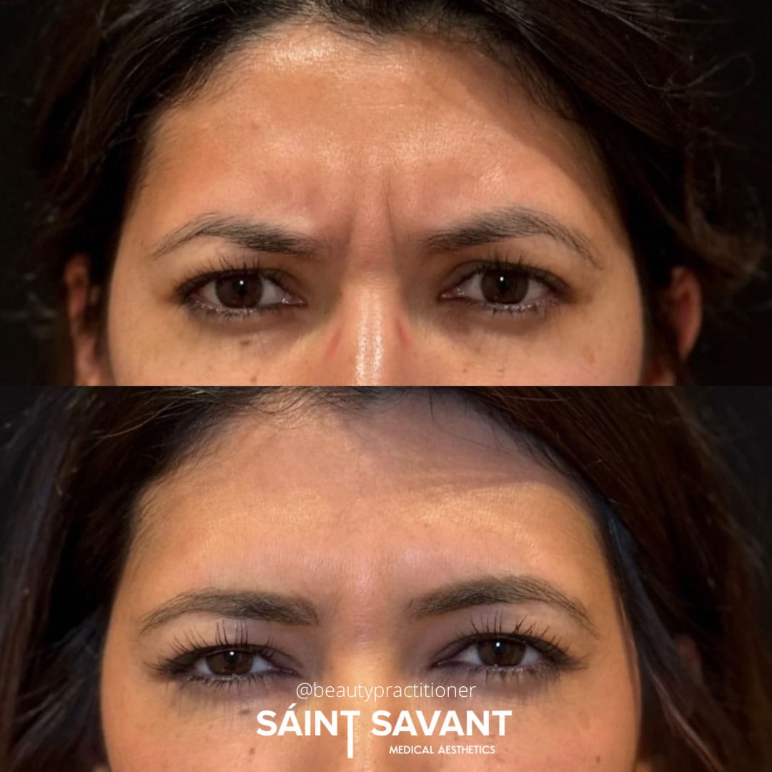 botox-10a