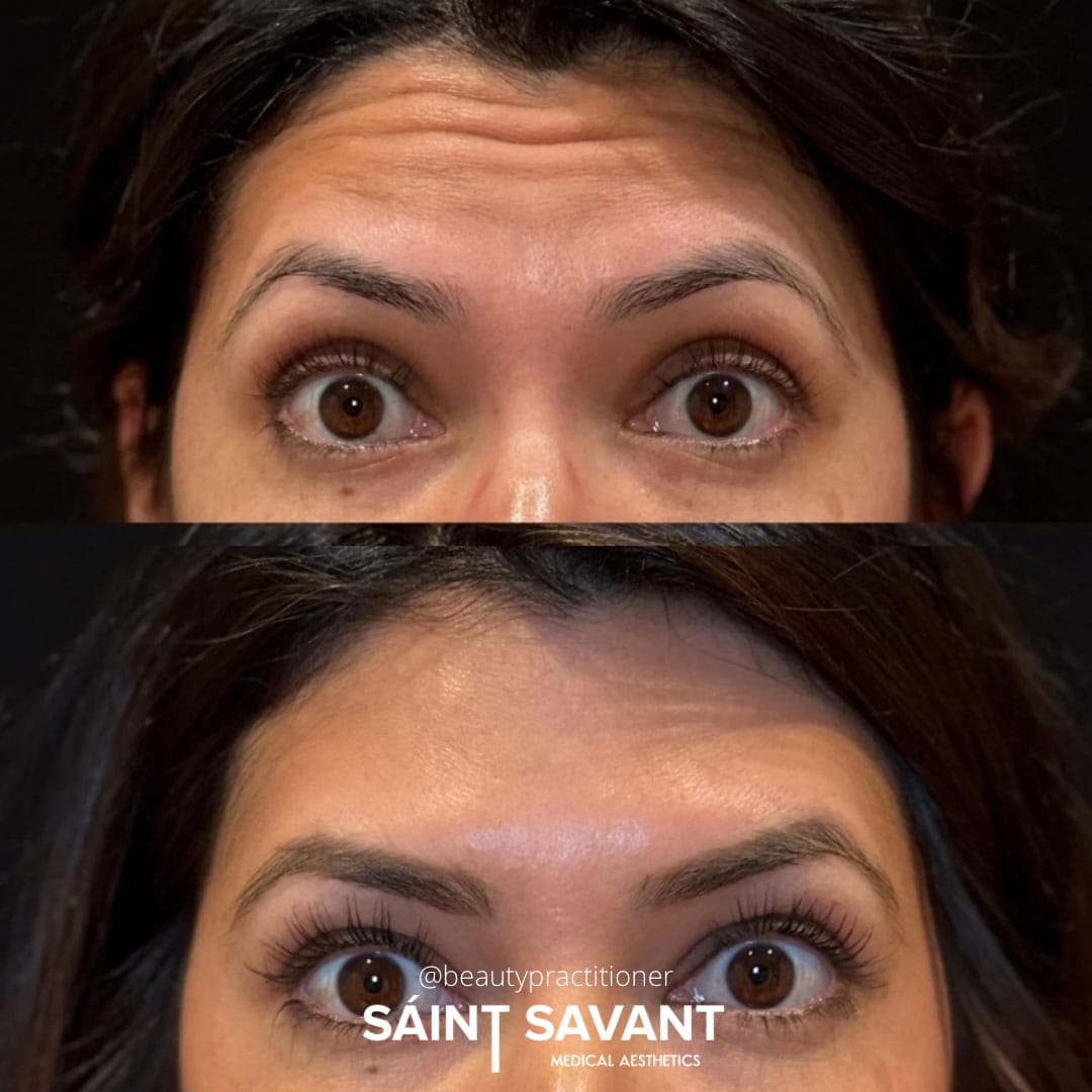 botox-10b