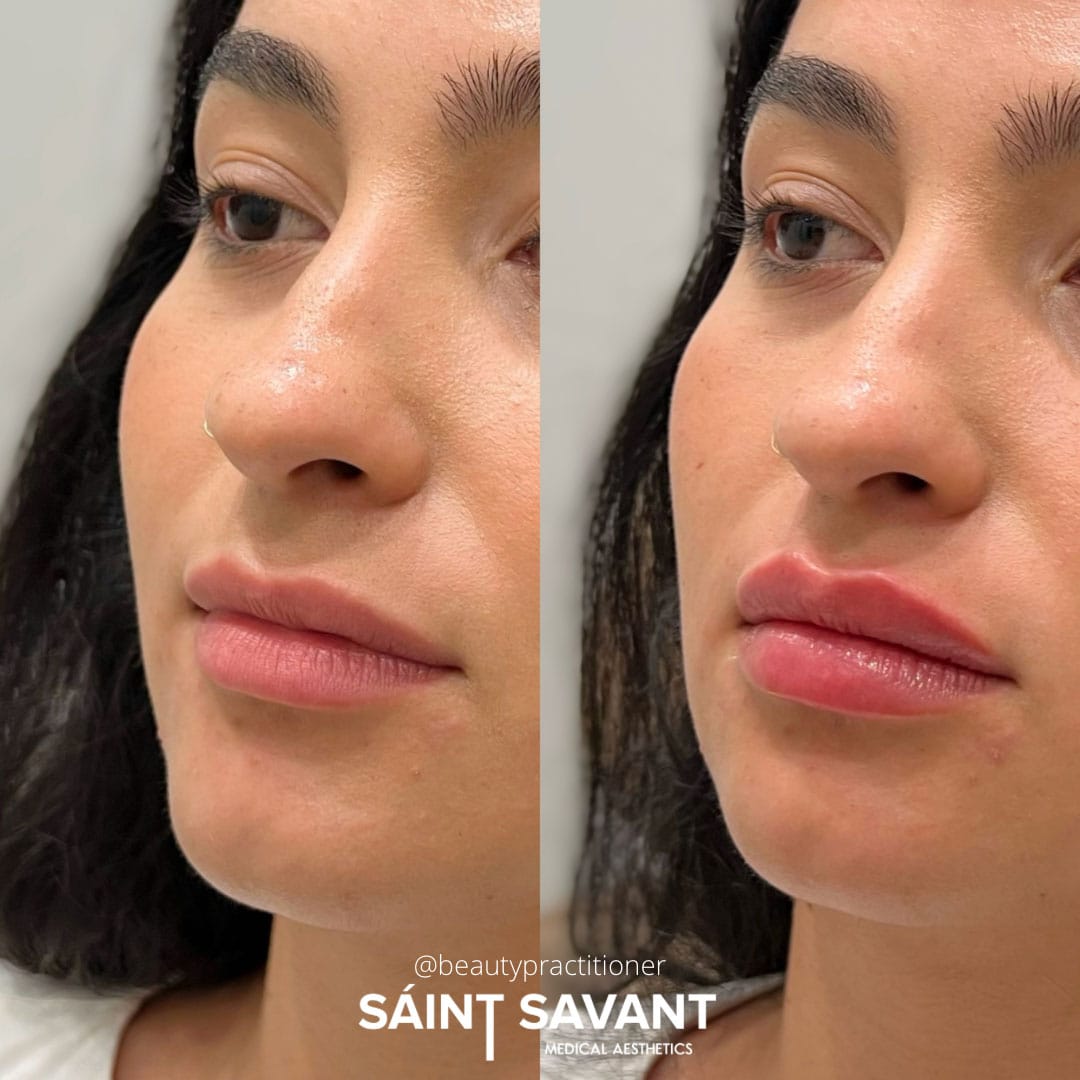 dermal-fillers-35a