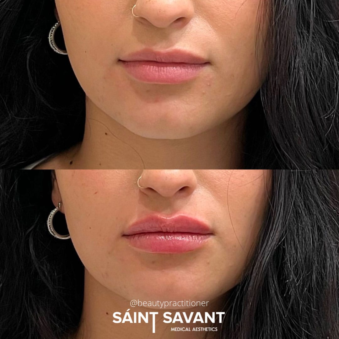 dermal-fillers-35b