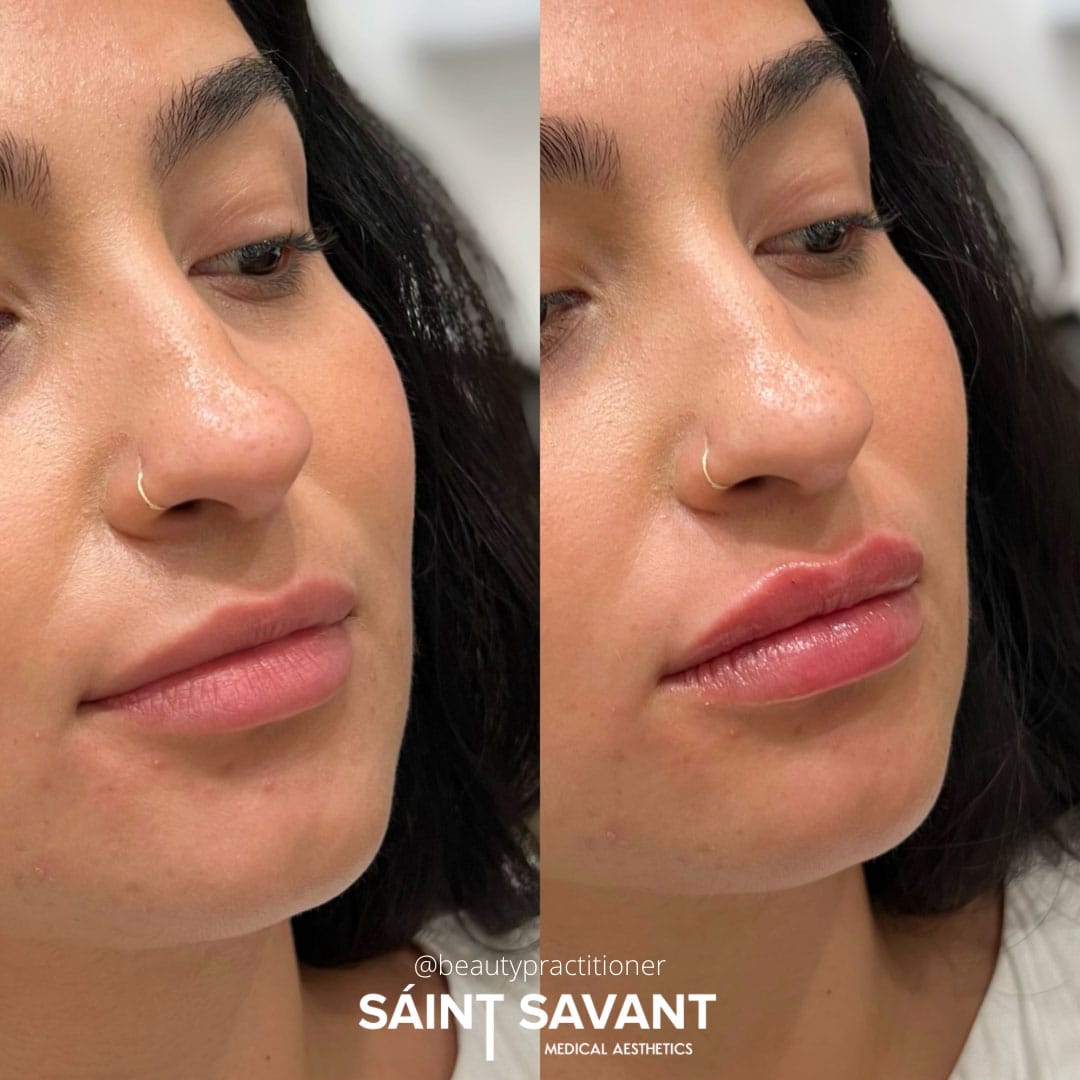 dermal-fillers-35c