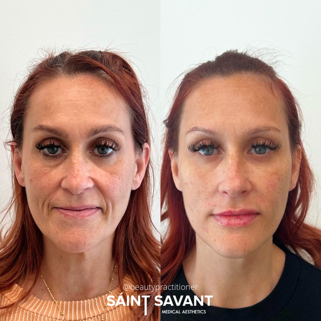 full-face-botox-under-eye-1a