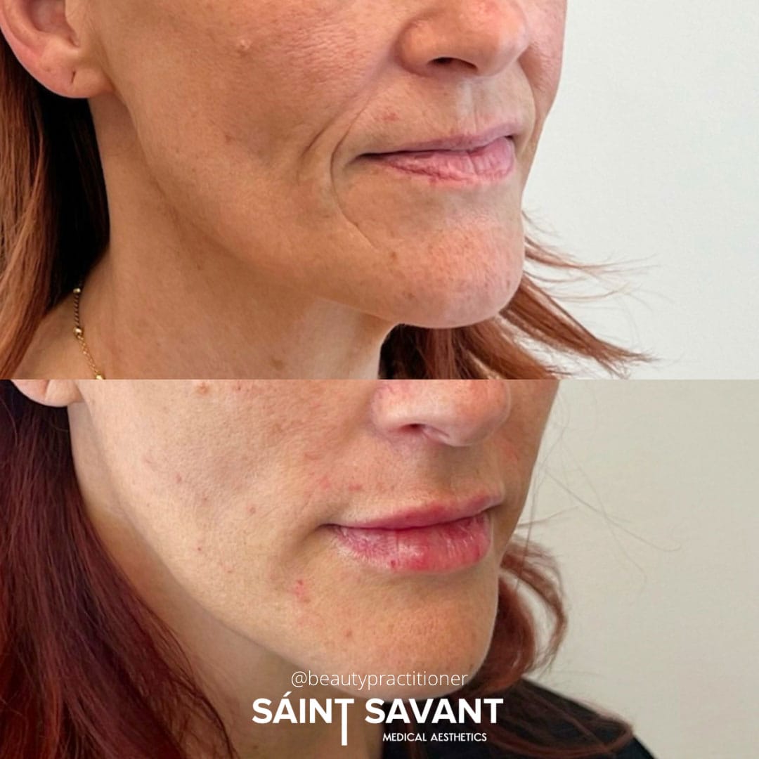 full-face-botox-under-eye-1b