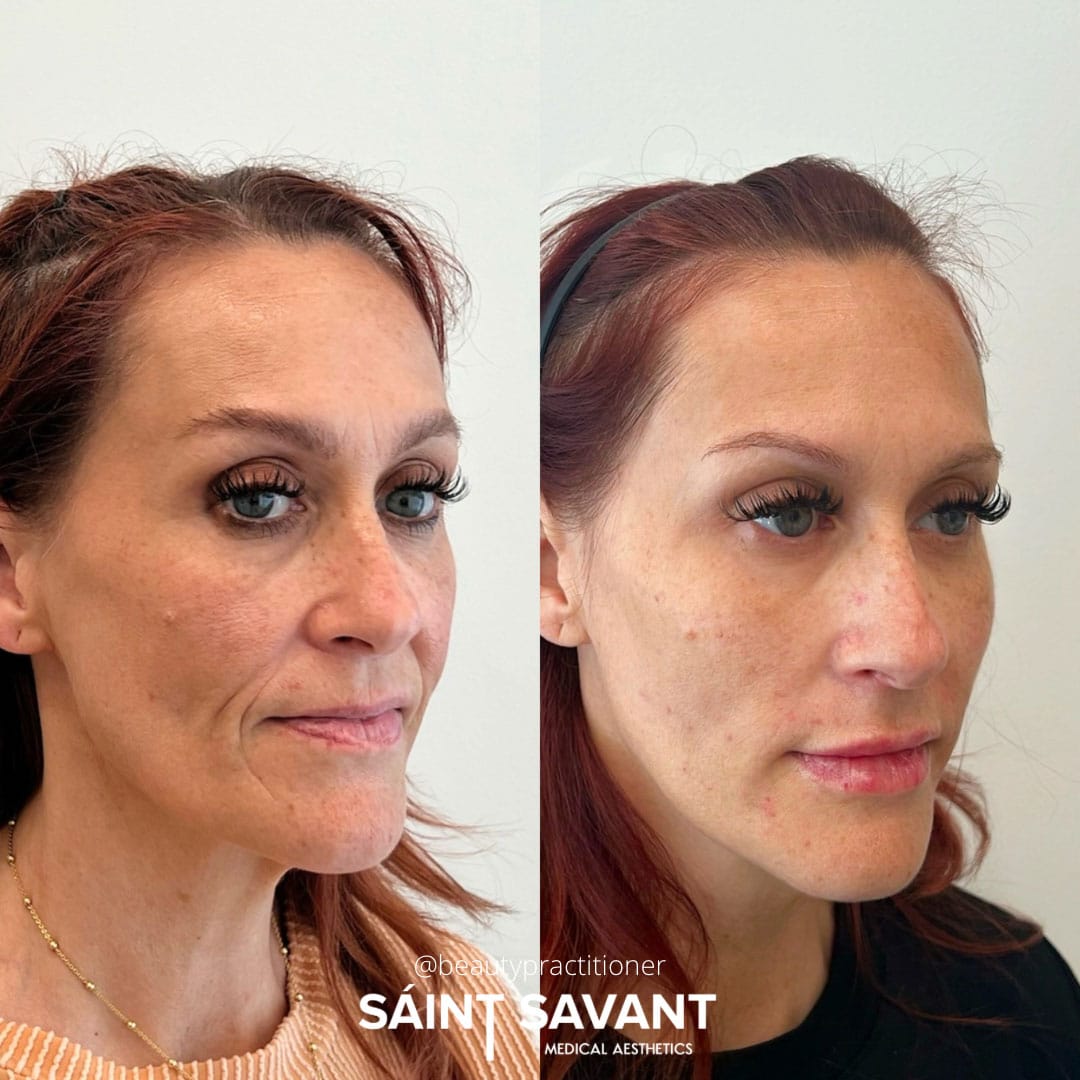 full-face-botox-under-eye-1c