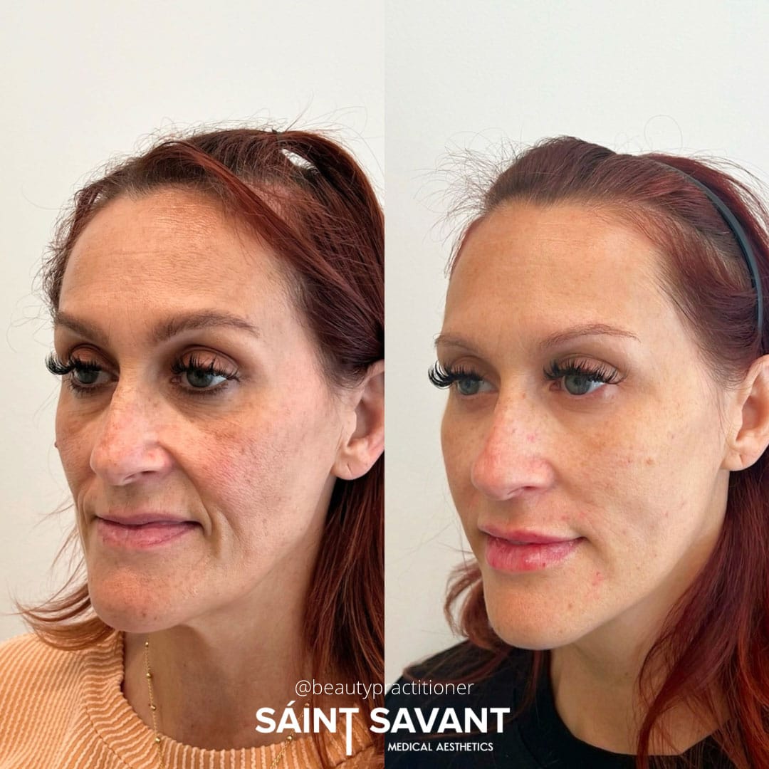 full-face-botox-under-eye-1d