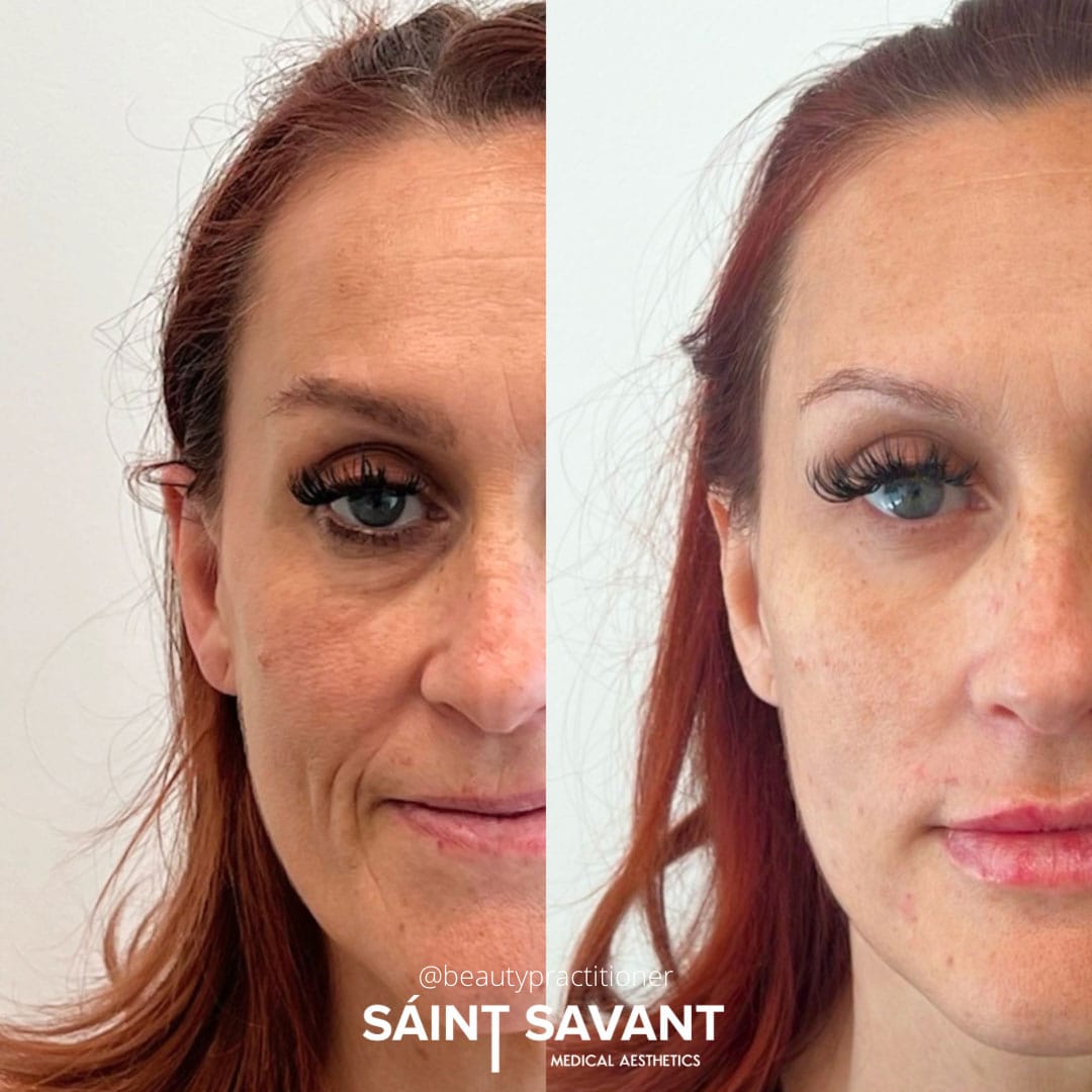 full-face-botox-under-eye-1e