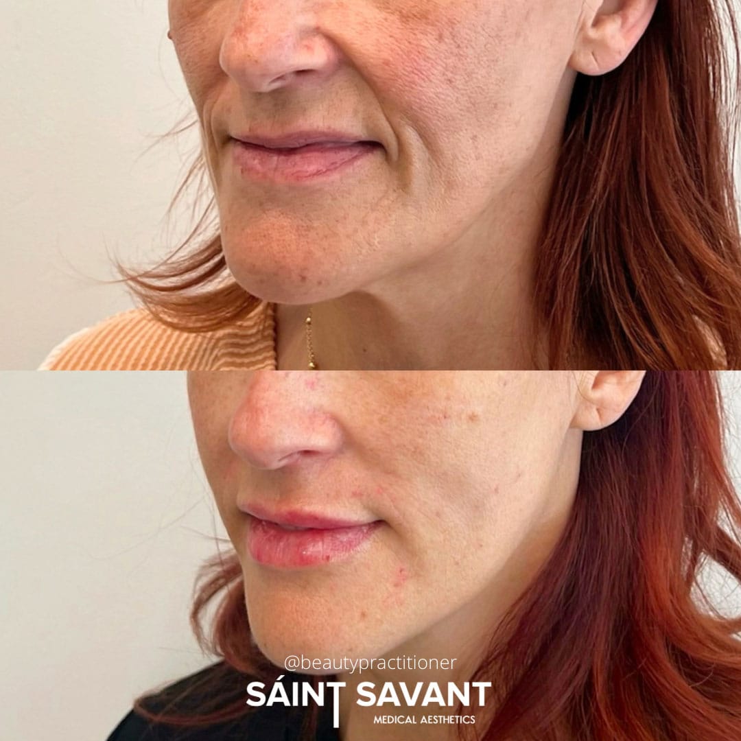 full-face-botox-under-eye-1f