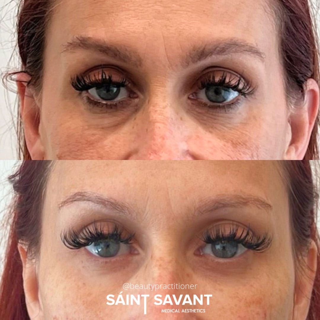 full-face-botox-under-eye-1g