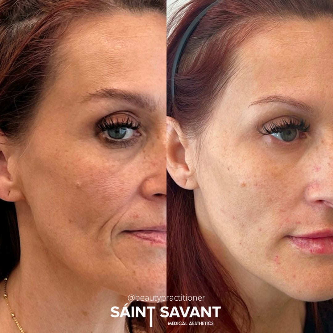 full-face-botox-under-eye-1h