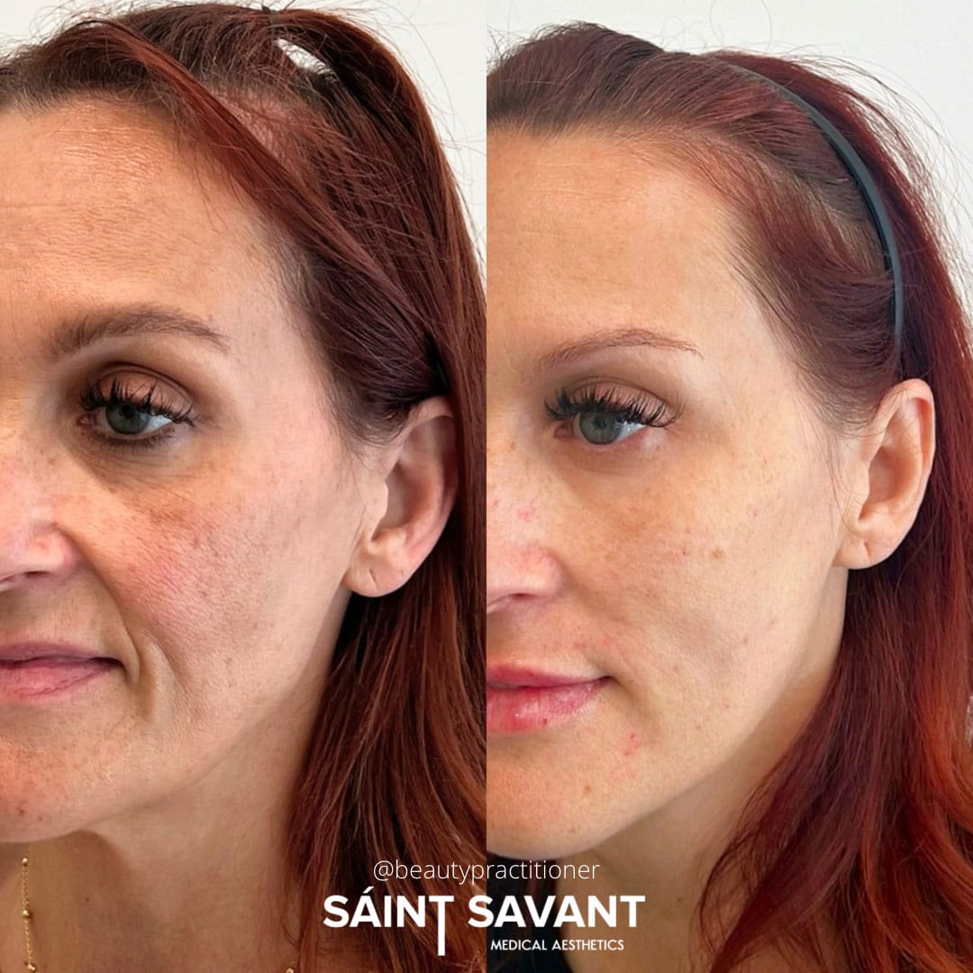 full-face-botox-under-eye-1i