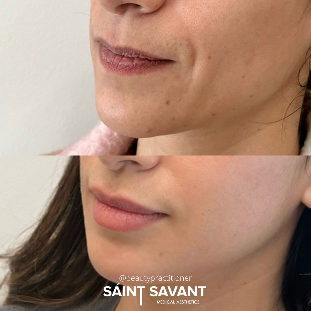 sculptra-dermal-fillers-1a