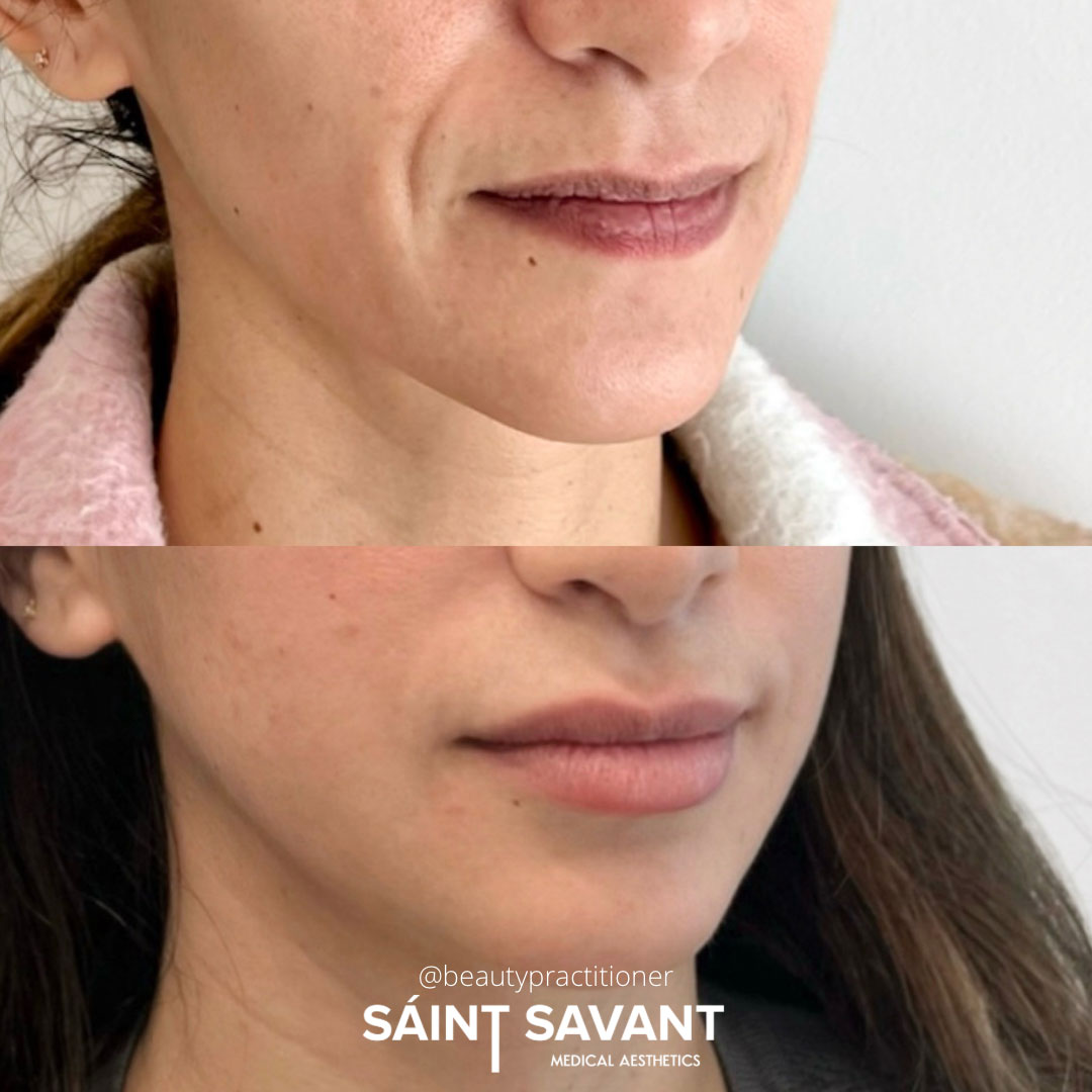 sculptra-dermal-fillers-1b