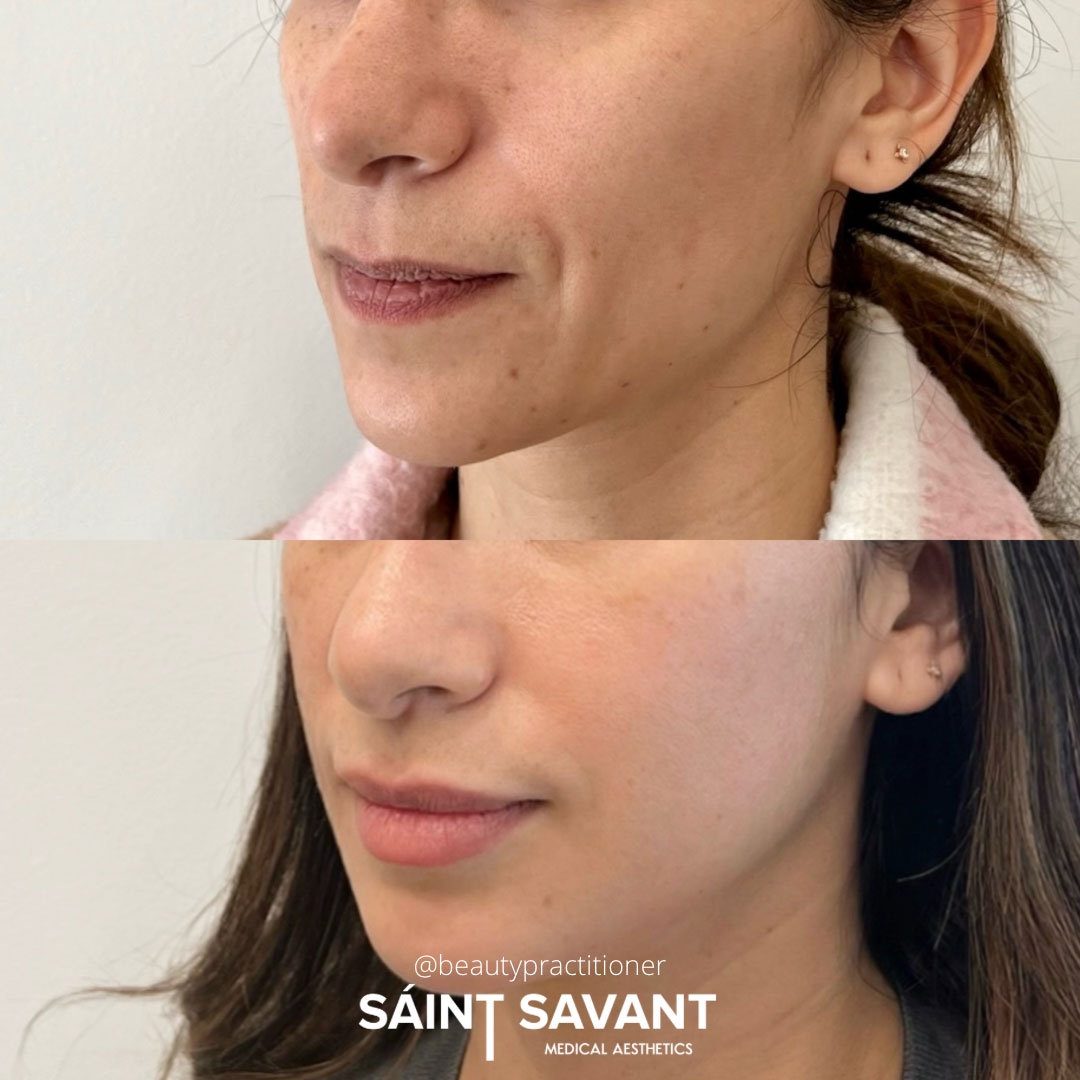 sculptra-dermal-fillers-1c