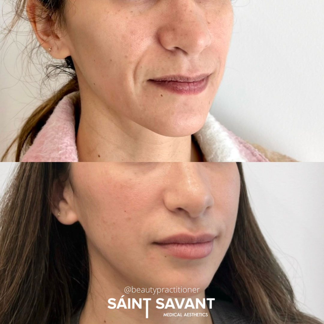 sculptra-dermal-fillers-1d