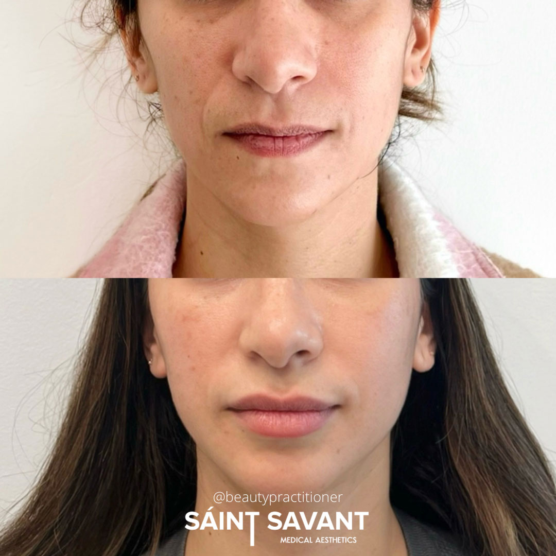 sculptra-dermal-fillers-1e