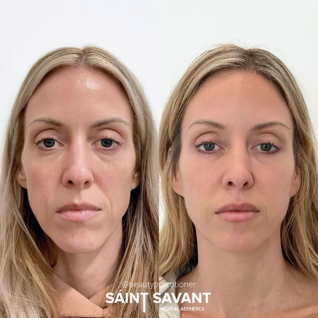 sculptra-dermal-fillers-2a