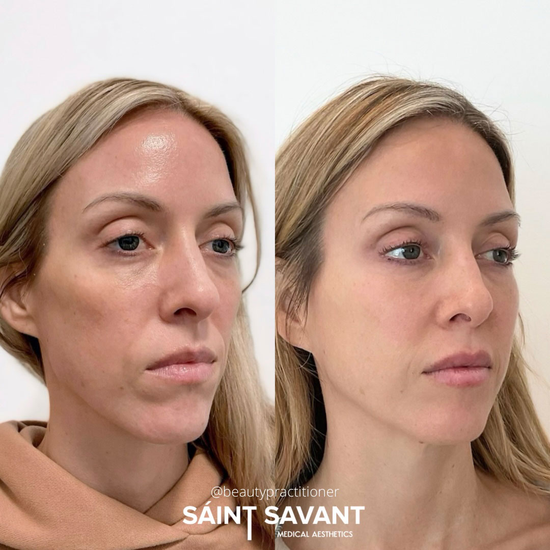sculptra-dermal-fillers-2b