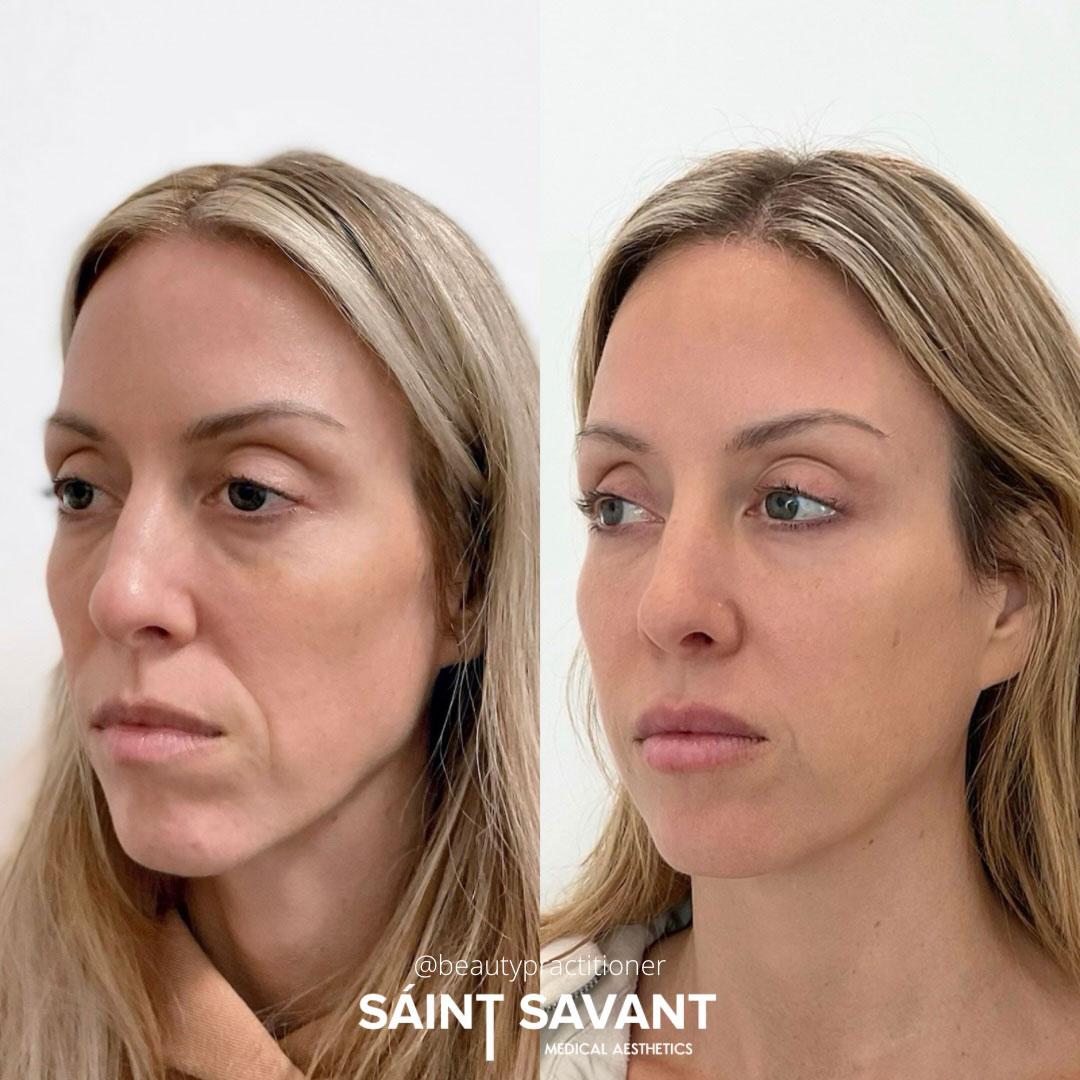 sculptra-dermal-fillers-2c